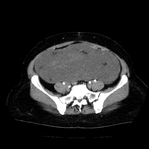Benign spindle cell tumor - abdominopelvic (Radiopaedia 61300-69212 A 45).jpg