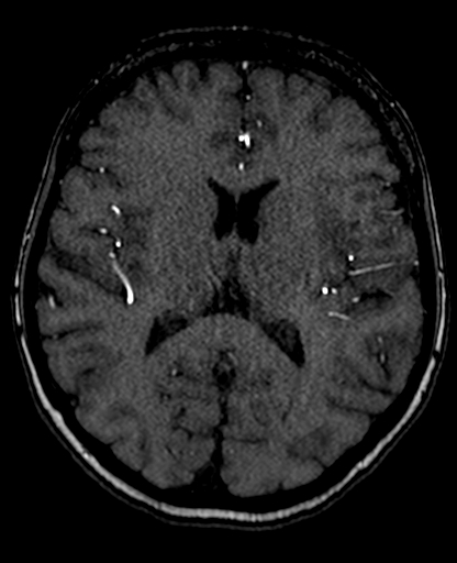 Berry aneurysm of the terminal internal carotid artery (Radiopaedia 88286-104918 Axial TOF 138).jpg