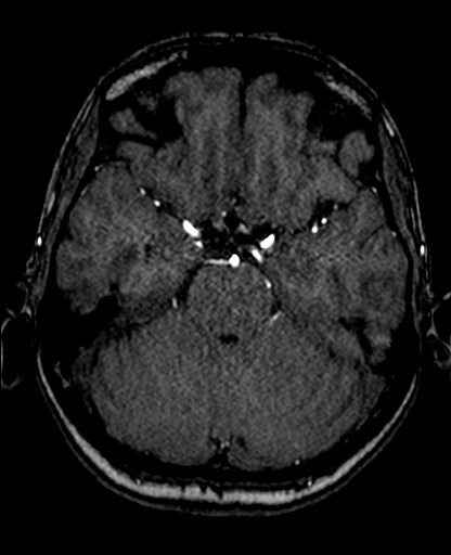 Berry aneurysm of the terminal internal carotid artery (Radiopaedia 88286-104918 Axial TOF 93).jpg