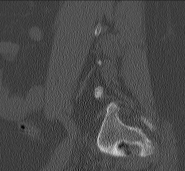 Bertolotti syndrome (Radiopaedia 24864-25128 Sagittal bone window 11).jpg
