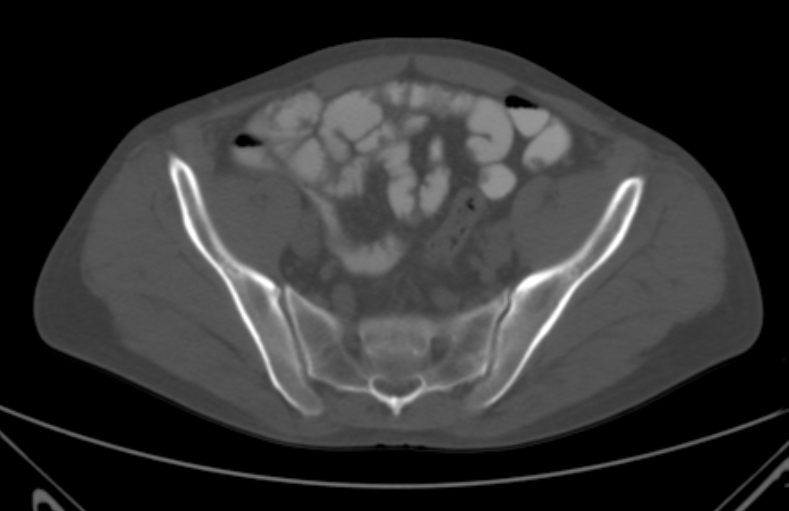 File:Bertolotti syndrome (Radiopaedia 58974-66235 Axial bone window 1).jpg