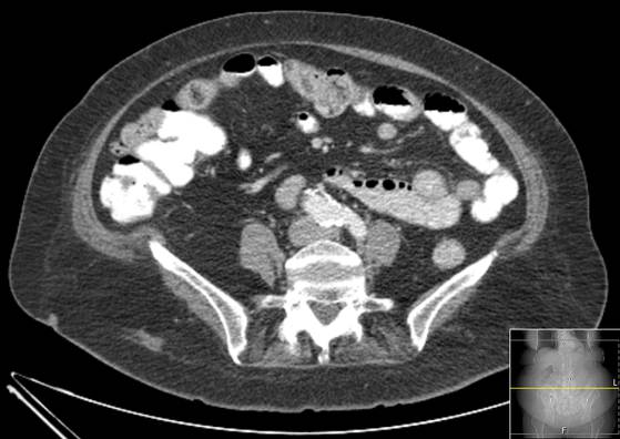 Bicameral celiacomesenteric aneurysm (Radiopaedia 55766-62327 A 41).jpg