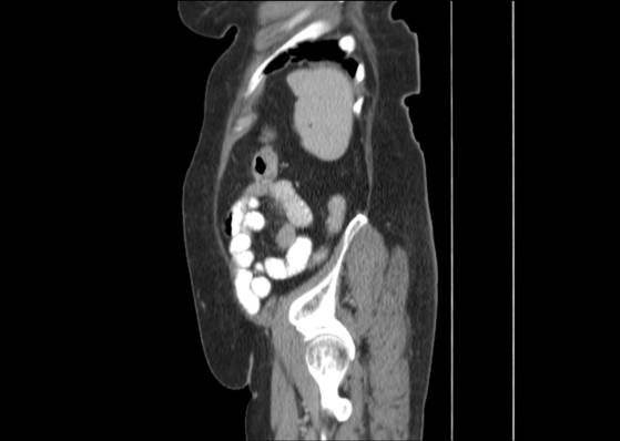 Bicameral celiacomesenteric aneurysm (Radiopaedia 55766-62327 B 47).jpg
