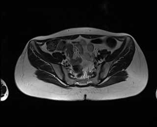 File:Bicornuate bicollis uterus (Radiopaedia 61626-69616 Axial T2 9).jpg