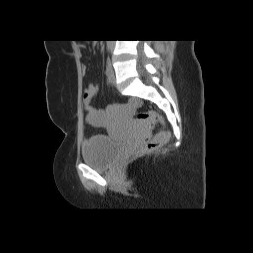 File:Bicornuate uterus- on MRI (Radiopaedia 49206-54296 A 9).jpg