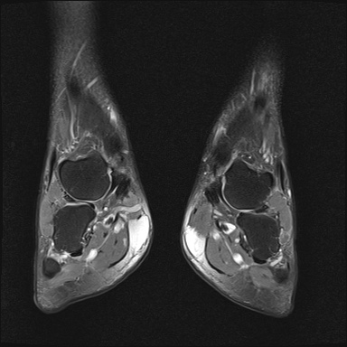 File:Bilateral Achilles tendon complete tear (Radiopaedia 81344-95051 Coronal PD fat sat 16).jpg