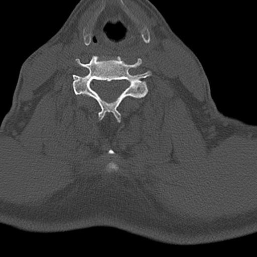 File:Bilateral C6-7 locked facet dislocation (Radiopaedia 28506-28748 Axial bone window 15).jpeg