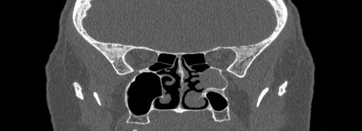 File:Bilateral Ectopic Infraorbital Nerves (Radiopaedia 49006-54084 Coronal bone window 51).jpg
