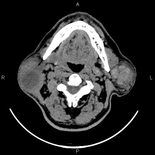 Bilateral Warthin tumors (Radiopaedia 84034-99263 Axial non-contrast 27).jpg