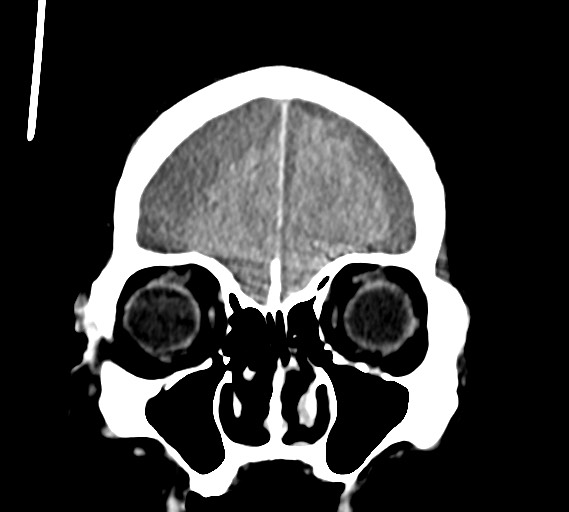 File:Bilateral acute on chronic subdural hematomas (Radiopaedia 78466-91146 Coronal non-contrast 15).jpg