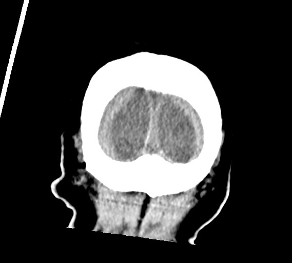 Bilateral acute on chronic subdural hematomas (Radiopaedia 78466-91146 Coronal non-contrast 63).jpg