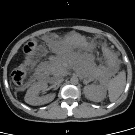 Bilateral adrenal gland hyperenhancement in pancreatitis (Radiopaedia 86642-102753 Axial non-contrast 44).jpg