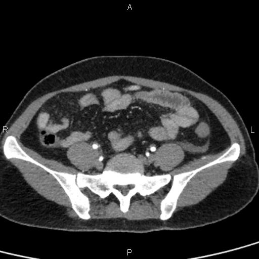 Bilateral adrenal gland hyperenhancement in pancreatitis (Radiopaedia 86642-102753 B 97).jpg