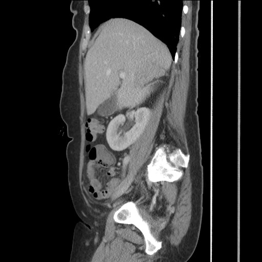 Bilateral adrenal granulocytic sarcomas (chloromas) (Radiopaedia 78375-91007 C 53).jpg