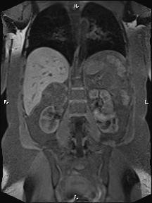 Bilateral adrenal myelolipoma (Radiopaedia 63058-71537 Coronal T1 fat sat 42).jpg