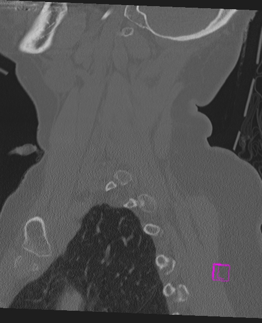 Bilateral atlanto-occipital assimilation (Radiopaedia 28350-28603 Sagittal bone window 61).jpg