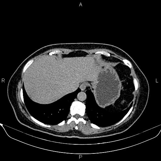 Bilateral benign adrenal adenomas (Radiopaedia 86912-103124 Axial C+ delayed 3).jpg