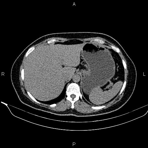 Bilateral benign adrenal adenomas (Radiopaedia 86912-103124 Axial non-contrast 27).jpg