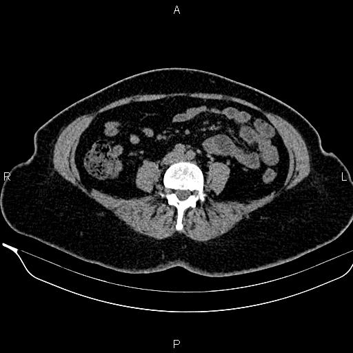 File:Bilateral benign adrenal adenomas (Radiopaedia 86912-103124 Axial non-contrast 70).jpg