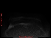 File:Bilateral breast implant rupture (Radiopaedia 24761-25027 DWI 33).jpg