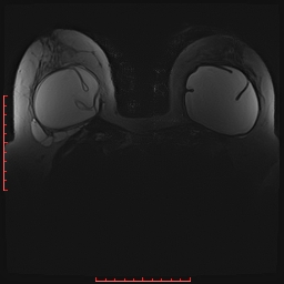 File:Bilateral breast implant rupture (Radiopaedia 24761-25027 PASTA Si 13).jpg