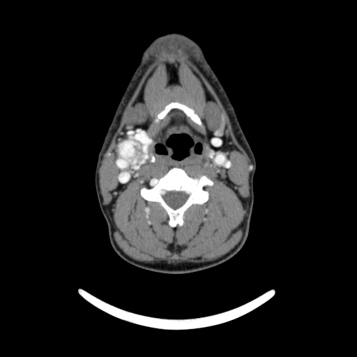 File:Bilateral carotid body tumors (Radiopaedia 52899-58827 A 3).jpg