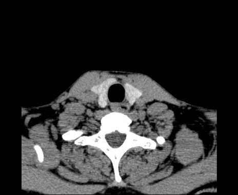 File:Bilateral carotid body tumors (Radiopaedia 61841-69870 Axial non-contrast 94).jpg