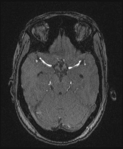 Bilateral carotid body tumors and right glomus jugulare tumor (Radiopaedia 20024-20060 Axial MRA 70).jpg