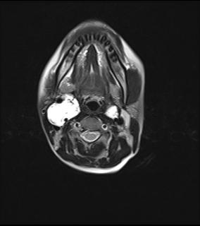 File:Bilateral carotid body tumors and right jugular paraganglioma (Radiopaedia 20024-20060 Axial 40).jpg