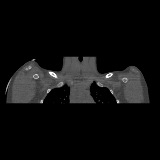 Bilateral chronic posterior shoulder dislocation (Radiopaedia 39213-41452 Coronal bone window 13).jpg