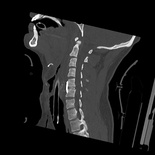 File:Bilateral locked facets (Radiopaedia 33850-35023 Sagittal bone window 35).png