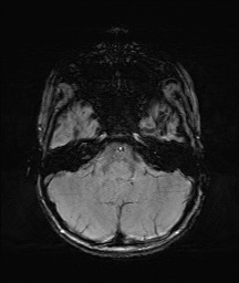 Bilateral mesial temporal polymicrogyria (Radiopaedia 76456-88181 Axial SWI 11).jpg