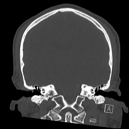 Bilateral occipital condyle fracture (type 2) (Radiopaedia 87675-104089 Coronal bone window 75).jpg