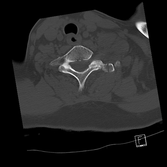 Bilateral occipital condyle fractures (type 3) (Radiopaedia 87672-104086 Axial bone window 64).jpg
