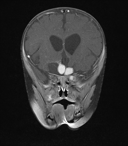 File:Bilateral optic pathway gliomas (Radiopaedia 40013-42514 D 6).jpg