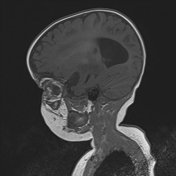 File:Bilateral optic pathway gliomas (Radiopaedia 40013-42514 Sagittal T1 23).jpg