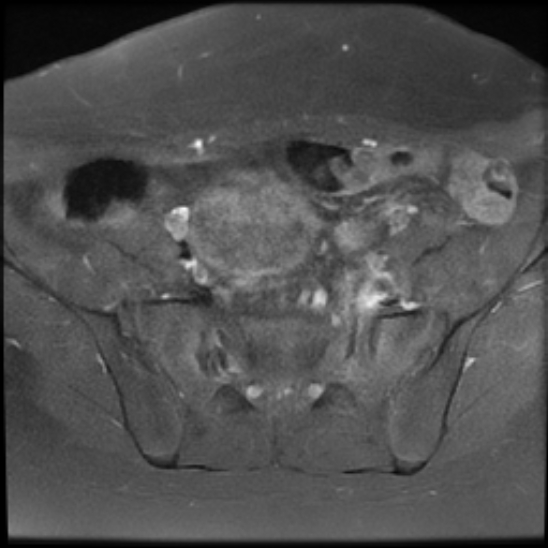 File:Bilateral ovarian fibrothecomas - adolescent (Radiopaedia 86604-102707 Axial T1 C+ fat sat 8).jpg