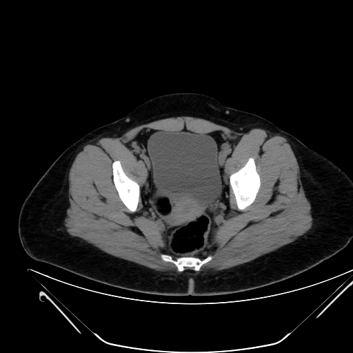 Bilateral ovarian mature cystic teratomas (Radiopaedia 79373-92457 Axial non-contrast 71).jpg