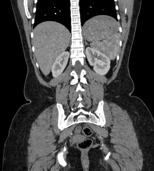 Bilateral ovarian mature cystic teratomas (Radiopaedia 79373-92457 B 74).jpg