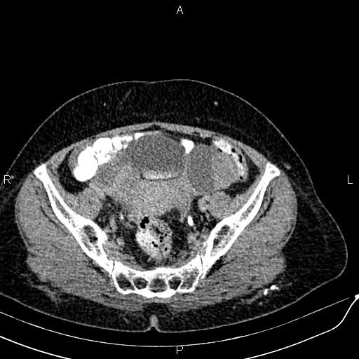Bilateral ovarian serous cystadenocarcinoma (Radiopaedia 86062-101989 Axial C+ delayed 64).jpg