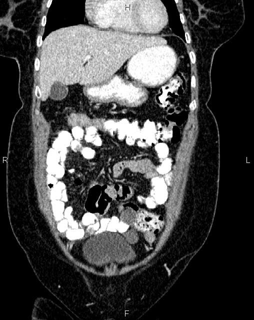 Bilateral ovarian serous cystadenocarcinoma (Radiopaedia 86062-101989 D 6).jpg