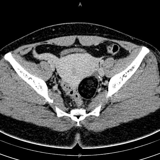 Bilateral ovarian teratoma (Radiopaedia 83131-97503 B 40).jpg