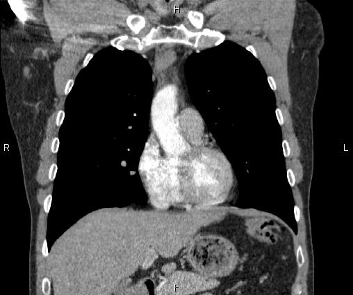 Bilateral pulmonary AVM (Radiopaedia 83134-97505 C 28).jpg