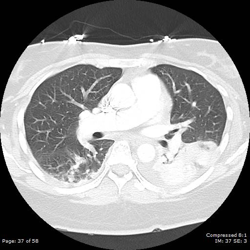 Bilateral pulmonary emboli with Hampton hump sign (Radiopaedia 54070-60246 Axial lung window 37).jpg
