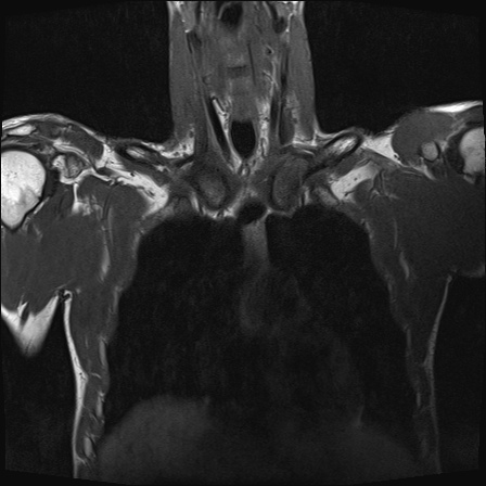 File:Bilateral spinoglenoid notch ganglion cysts (Radiopaedia 29577-30082 Coronal T1 7).jpg