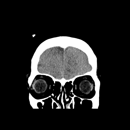 Bilateral subacute subdural hematoma (Radiopaedia 69240-79018 Coronal non-contrast 8).jpg