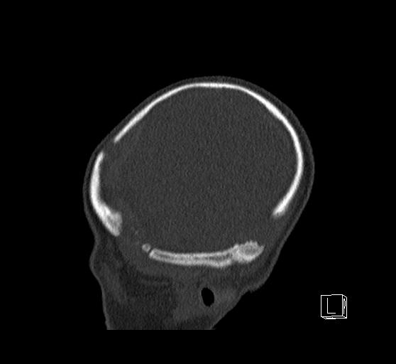 Bilateral subdural hemorrhage and parietal skull fracture (Radiopaedia 26058-26192 Sagittal bone window 12).png