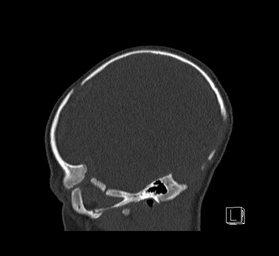 Bilateral subdural hemorrhage and parietal skull fracture (Radiopaedia 26058-26192 Sagittal bone window 17).png