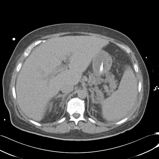 Bladder rupture post renal biopsy (Radiopaedia 30863-31572 Axial non-contrast 24).jpg