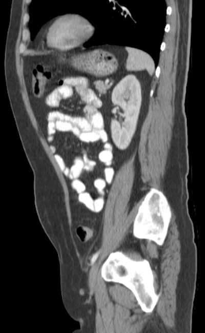Bleeding duodenal ulcer and adenomyomatosis of gallbladder (Radiopaedia 61834-69861 C 71).jpg